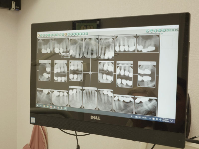 Tooth Extraction Dentists Plymouth MI